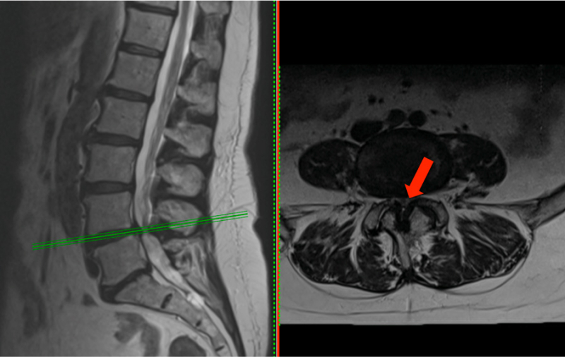 What Are The Final Stages of Spinal Stenosis?